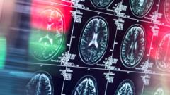 EU regulator rejects Alzheimer’s drug lecanemab