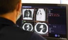 ‘Amazing’ trial shows drug combination stops lung cancer advancing for longer