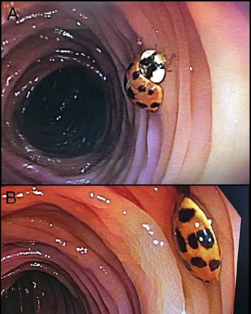 World’s first case of an alive ladybug found in someone’s colon during colonoscopy