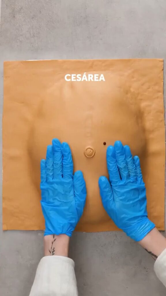 How a caesarean section is performed..