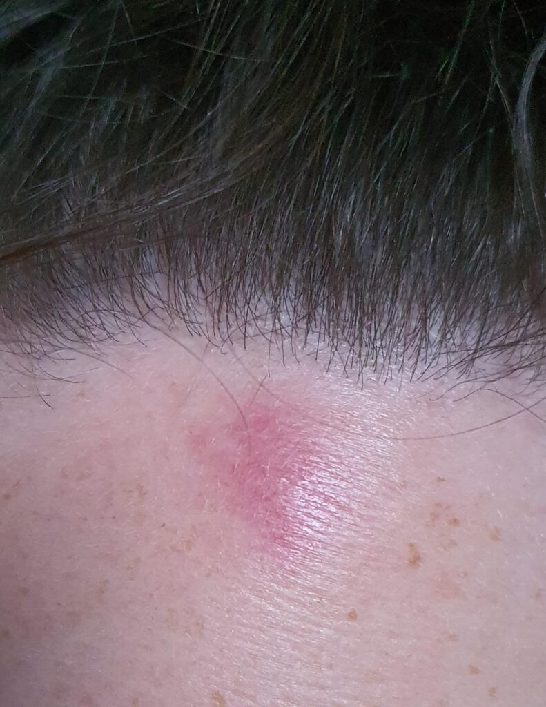 My GF got a mosquito bite on her forehead 9 months ago and it still randomly shows up