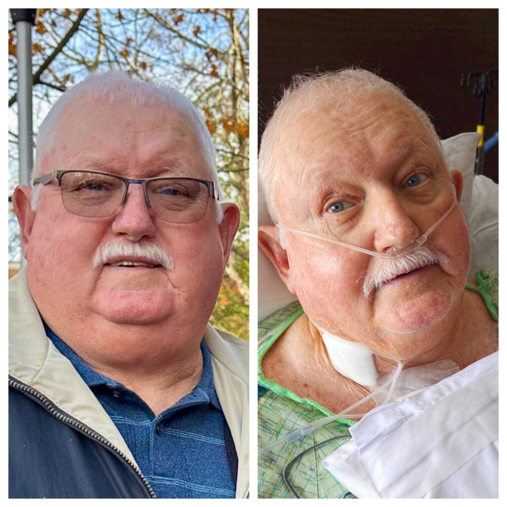 7 days difference in my daddy’s face: Left is 5 days pre-open heart surgery, right is 2 days post-surgery