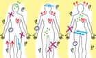 ‘We think of the body as a map’: a new approach to deciphering long Covid