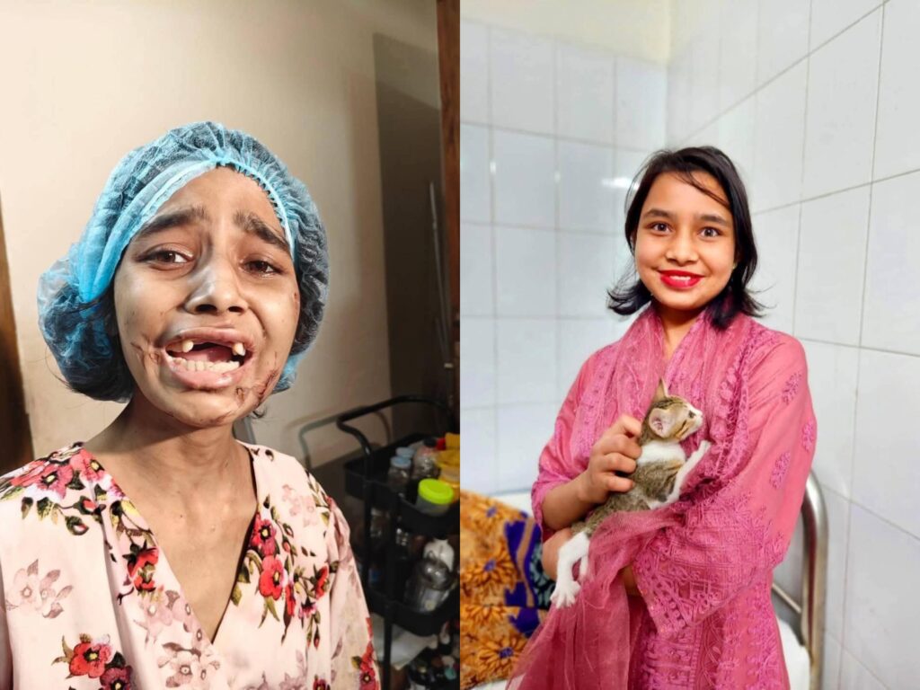 Before and after of a girl(Kolpona) rescued from extreme abuse in Bangladesh