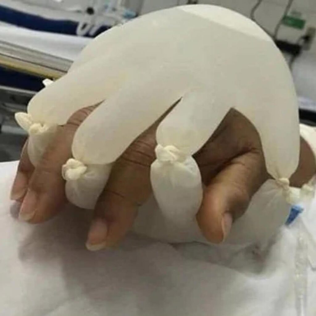 Nurses tie two gloves filled with hot water to stimulate the human touch and to comfort the isolated patients.