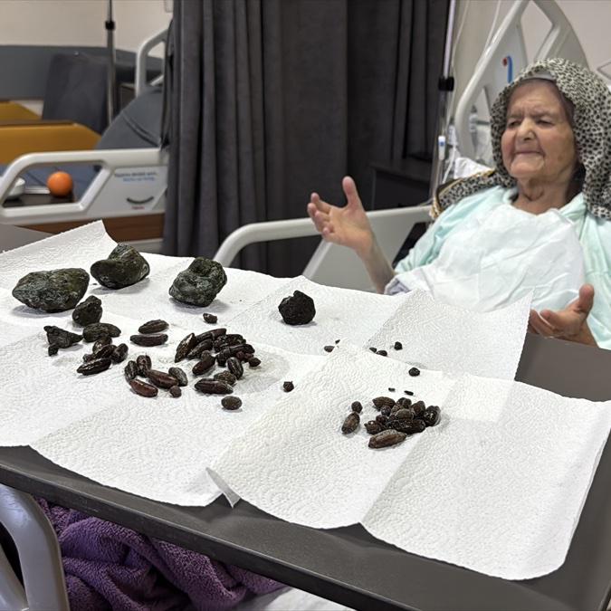 In Turkey, 35 olives, 28 date seeds and 5 stones were removed from the stomach and intestines of a 92-year-old woman.